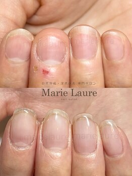 マリーロール 梅田店(Marie Laure)/自爪育成/深爪矯正/ネイルケア