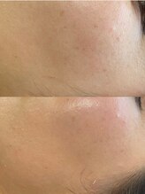 ユウビビューティサロン 東生駒(Yuubi Beauty Salon)/【peel stage】ハーブピーリング