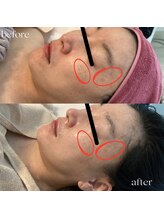 ユルリ(YURURI)/ビフォーアフター（肌荒れケア）