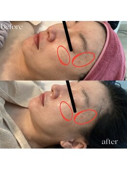 ユルリ(YURURI)/ビフォーアフター（肌荒れケア）