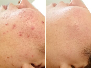 ハダイ(HADAY)/ニキビ改善｜ハーブピーリング