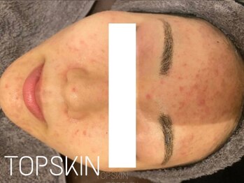 トップスキン 名駅(TOPSKIN)/繰り返すニキビにTCLINEハーブ◎