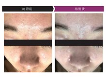 パーフェクトフェイスビューティー 梅田店(PERFECT FACE BEAUTY)/ディレイアコスメ（5種）使用