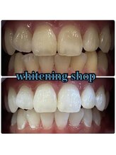 ホワイトニングショップ 天王寺店/40分照射×10回 50代女性