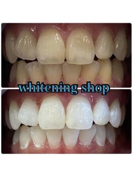 ホワイトニングショップ 天王寺店/40分照射×10回 50代女性