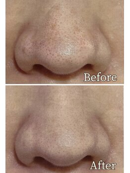 シェルナ(CIELNA)/毛穴洗浄