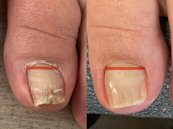 爪のいろはの写真/【巻き爪補正】巻き爪のつらい痛み、深爪等のトラブルケアはプロのスタッフにお任せください♪[フットケア]