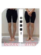 スタイルラボ高松/O脚矯正の効果♪