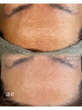 アエ(ae)/ダクトピール