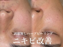 サロン ムスブ(salon MUSUBU)/剥離無しハーブピーリング