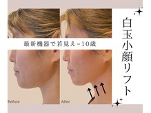 アトランティカ(ATLANTICA)/【小顔造顔】白玉小顔リフト