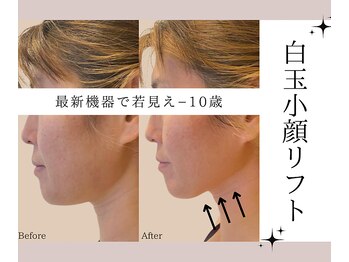 アトランティカ(ATLANTICA)/【小顔造顔】白玉小顔リフト