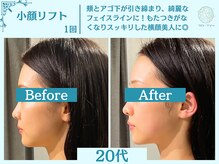 フローフシ∞/【小顔】切らない小顔リフト