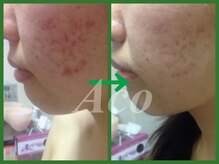 ハーブピーリングの本流、グリーンピールで輝く素肌へ13200円～