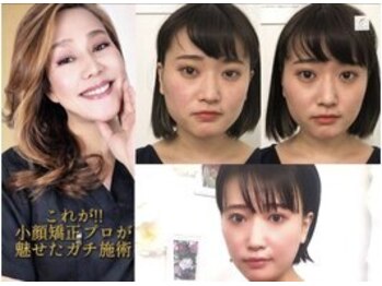サロンチオリ 烏丸(Salon Chiori)の写真/【40代から切らない小顔】糸リフト前に!独自の口内筋ケアでエラ張り・顔の伸びを徹底ケア!内側から上向きに