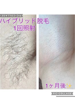 サロン ド ソレイユ(Salon.de.Soleil)/ワキ脱毛