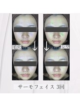 レイジュ(reiju)/サーモフェイシャル　3回