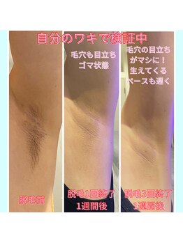 ワイズサロン(Y's salon)/ワキ脱毛の経過