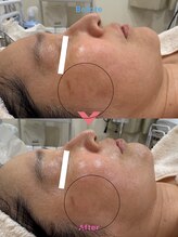 ルポアン(Repos an)/プロ扱えない高濃度レチノール！