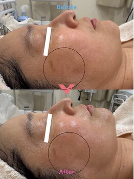 ルポアン(Repos an)/プロ扱えない高濃度レチノール!