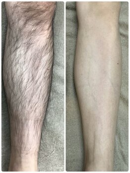 アルシスタ(ARCISTA)/【メンズ脱毛】