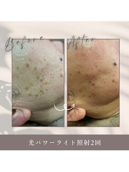 メディカルサロン フィオレ(fiore)/光パワーライトフェイシャル効果