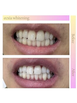 エクシアホワイトニング 天王寺店/ホワイトニングビフォーアフター