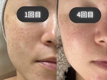 ライリー(Rairy)の雰囲気（【たるみ/シミ/シワ】最強肌質改善！次世代ダ - マプラズマ）