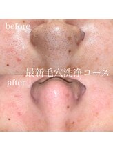 ポノ(Pono)/最新毛穴洗浄コース