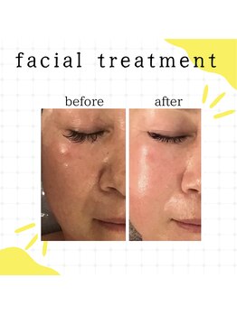 ミュー(professional beauty salon MYU)/艶玉ドレナージュ☆小顔