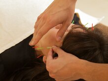 セントラルたなか鍼灸院 上社院/・美容鍼の施術風景