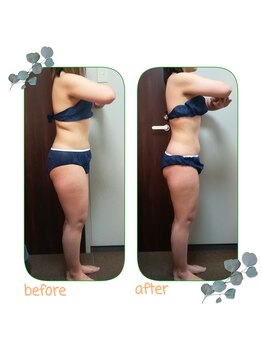 ダイエット サポート(DIET SUPPORT)/短期&グロッティ 施術結果