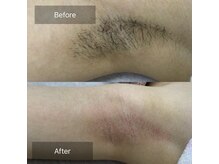 アルゴ 八幡黒崎店(ALGO)/初回のbefore、after