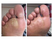 厚木 海老名 巻き爪矯正センター/事例【ドイツ式フットケア】