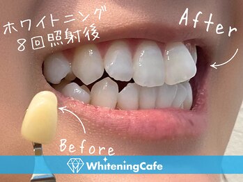 ホワイトニングカフェ 志木店/ホワイトニングビフォーアフター
