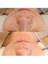 リバージュ(Riverge)/肌改善(3ヶ月)