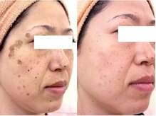 シミの症例です。