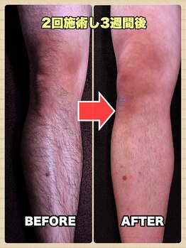 ミルラ(MYRRH)の写真/【メンズ全身脱毛】脱毛デビューにもオススメ◎男性も脱毛が当たり前!身だしなみをサポート!