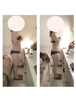 アクア エステティコ 亀有(ACQUA estetico)/上半身 3ヶ月変化 40代