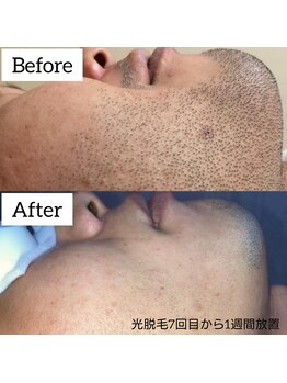 ジュゴン(Dugong)/髭脱毛（Before＆After）