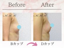 エムエムエム 表参道Luxeサロン(M.M.M)/【バストアップ例】　B→Dカップ