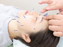 たかはし整骨院の雰囲気（美容鍼　　自然治癒力を高めます）