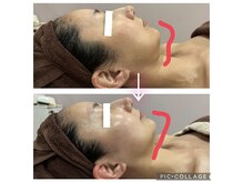 プロラボスパ 新宿店/30代　小顔症例