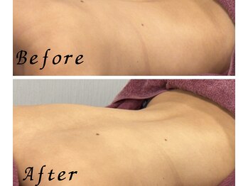 アイリーボーテ 東大阪(アイリーBEAUTE)/背中・二の腕つるすべ！