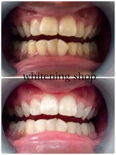 ホワイトニングショップ 北千住店/ホワイトニング高そう