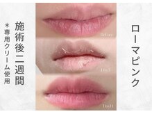 芯美 恵比寿店(shinbi)/ローマピンク施術後２週間