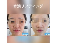 ココスタイルビューティー(COCOSTYLE beauty)の雰囲気（最近リフティング！たるみ，ゆるみ，シワ感想、くすみケア！）