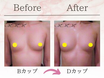 エムエムエム 表参道Luxeサロン(M.M.M)/【バストアップ例】　B→Dカップ