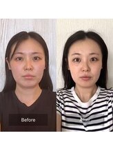 ハッピービューティーサロン じゆう(Happy Beauty Salon J∞YOU)/人気No.1/魔法の小顔矯正/1回目