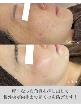 リニューサロン 本院(renew salon)/紫外線リセット☆